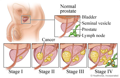 Prostate Cancer